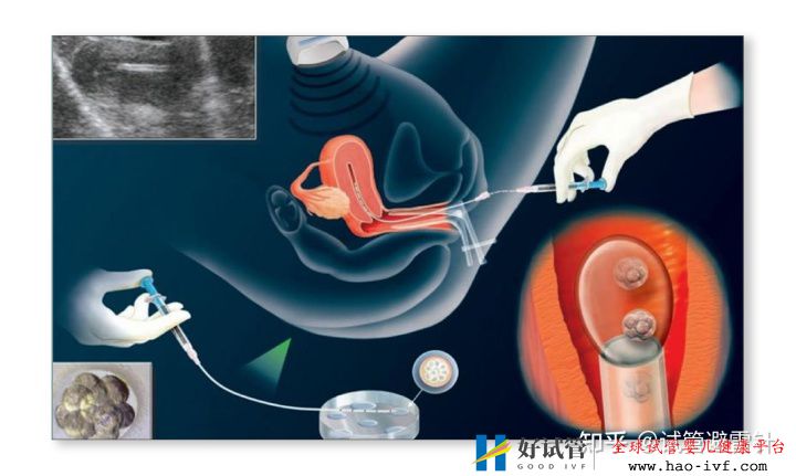 试管婴儿费用大约多少2021年——3.国内一二代试管婴...(图15) 试管婴儿费用大约多少2021年——3.国内一二代试管婴...(图15)