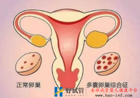多囊卵巢综合征对试管婴儿有什么影响(图1) 多囊卵巢综合征对试管婴儿有什么影响(图1)