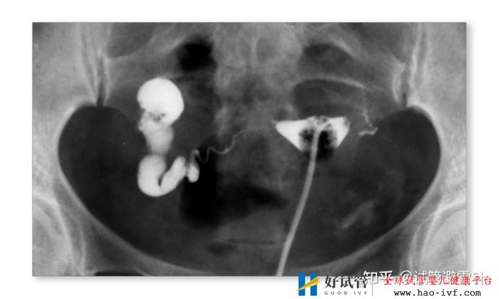 试管婴儿需要什么条件才可以做——系列文1最全面...(图1) 试管婴儿需要什么条件才可以做——系列文1最全面...(图1)