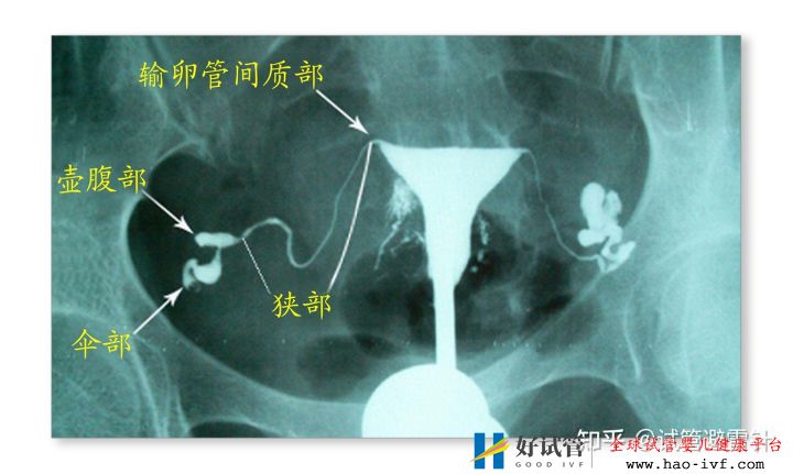 试管婴儿需要什么条件才可以做——系列文2(图2) 试管婴儿需要什么条件才可以做——系列文2(图2)
