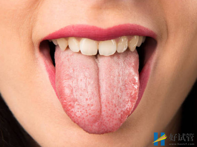 看孕妇舌头也能看生男生女,舌苔发白生男孩概率大!(图3) 舌苔发白不是生男孩