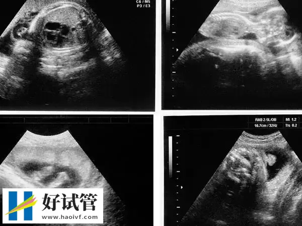 安顺试管婴儿移植第38天孕囊应该多大(图1) 着床后就会开始有孕囊