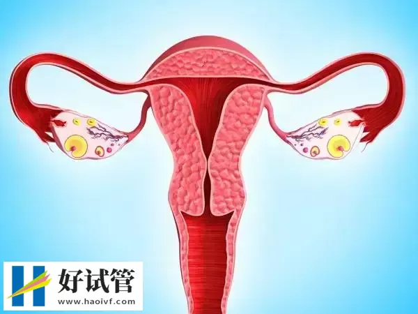 凉山子宫内膜异位症试管婴儿适合什么方案(图1) 子宫内膜异位症做试管成功率不低
