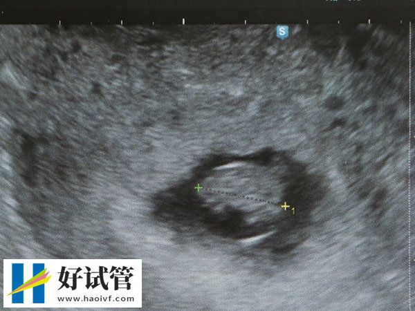 单囊胚移植不光能减少并发症,女性经济、身体压力也会变小(图2) 单囊胚移植成功率怎么样