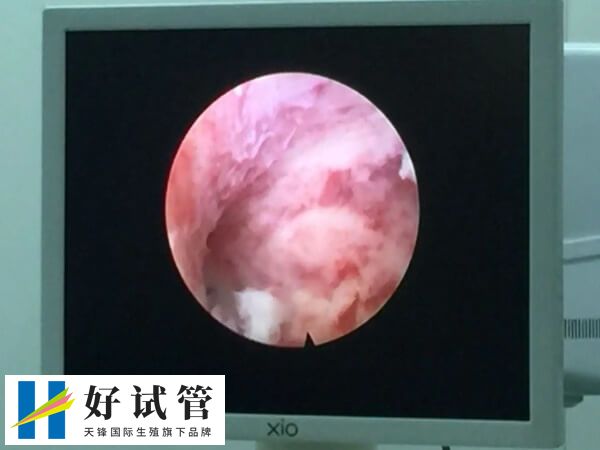 做试管宫腔镜后多久移植最佳(图2) 宫腔镜能够排查子宫问题