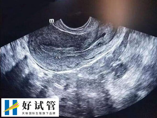 宫颈息肉试管老是生化怎么办(图2) 宫颈息肉通常是由缓慢炎症引起的