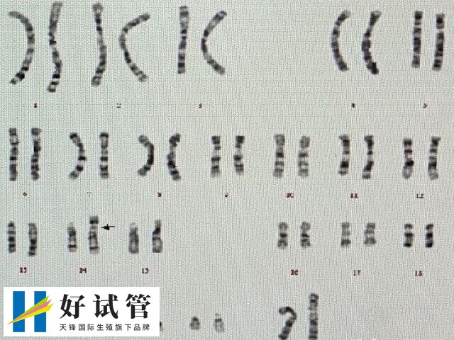 三代试管短方案如何进周(图1) 三代试管短方案进周前需进行建档