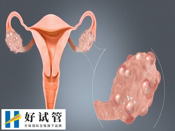 输卵管存在炎症大部分会有积水