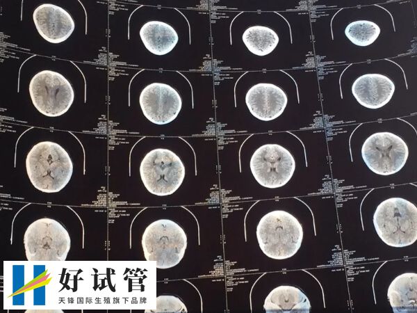 多发性骨软骨瘤是一种常染色体显性遗传病